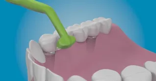 بهترین مسواک مخصوص ایمپلنت در بازار چیست؟