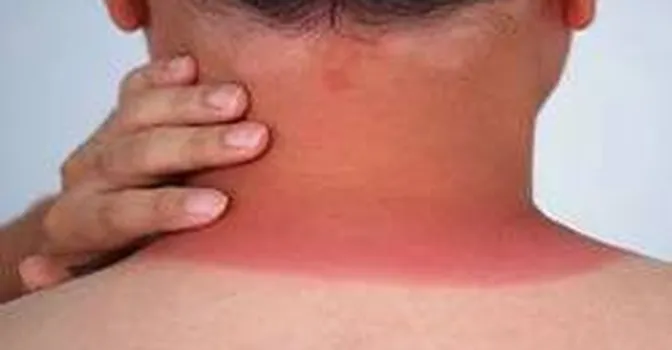 20 روش درمان خانگی آفتاب سوختگی؛ از حمام شیر تا ماسک‌های خانگی