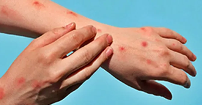 😷 سازمان جهانی بهداشت اعلام کرد که ام پاکس «کووید جدید» نیست!