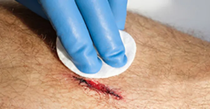 راهنمای مراقبت از زخم باز؛ نکاتی برای بهبود سریع و جلوگیری از عفونت