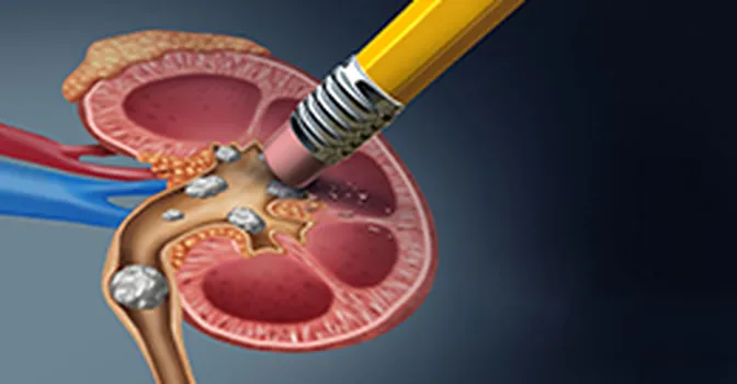 مراحل دفع سنگ کلیه و علائم افتادن سنگ کلیه در مثانه
